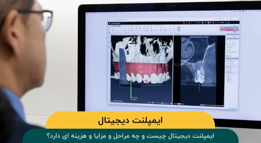ایمپلنت-دیجیتال